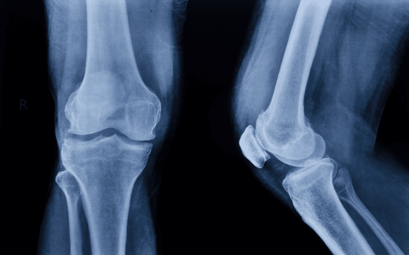 x-ray image of knee bones